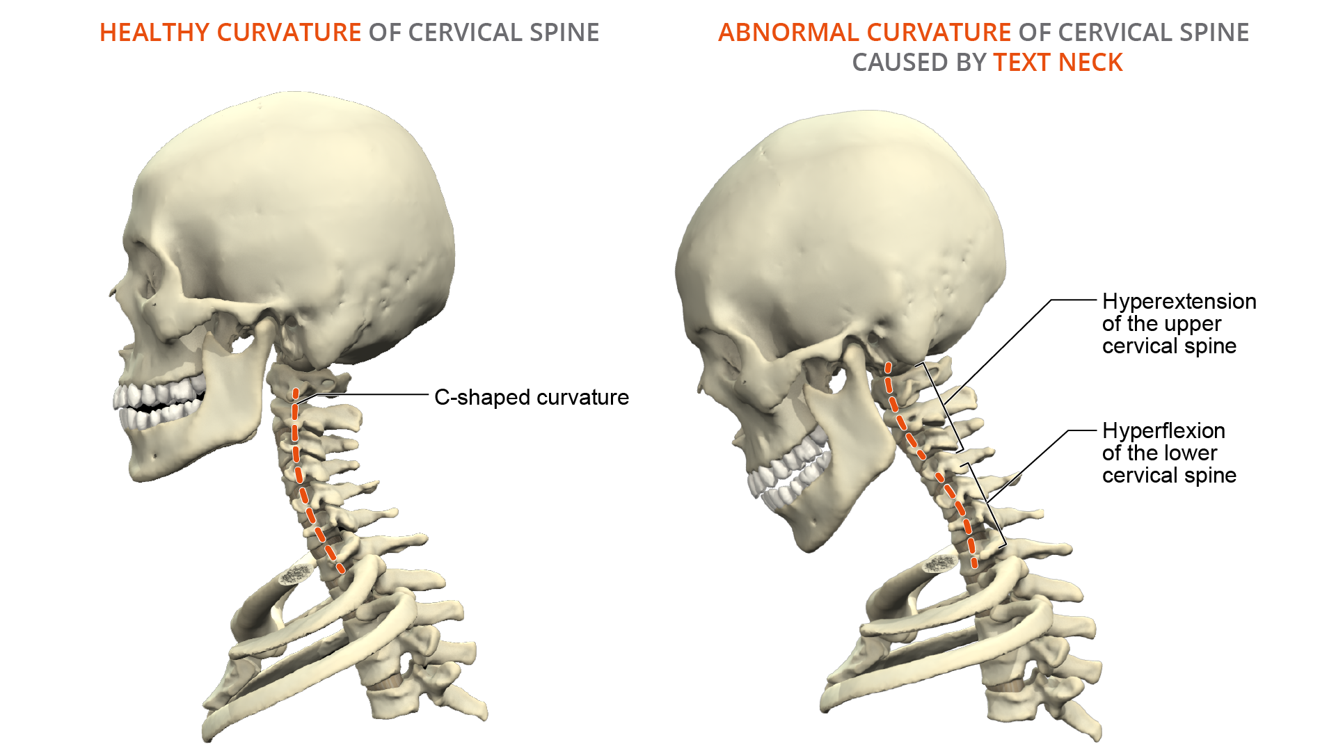 Text Neck Anatomy of a Modern Spine Condition